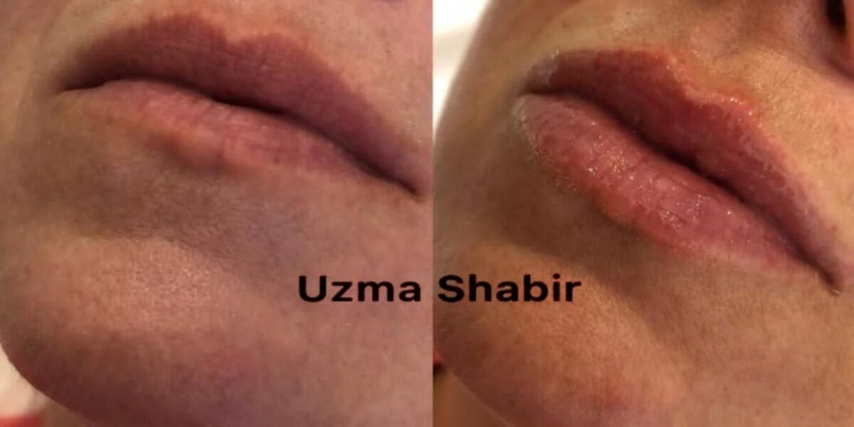 خبيرة التجميل عظمي شبير/ Uzma Shbr خبيرة في مجال حقن الفيلر
